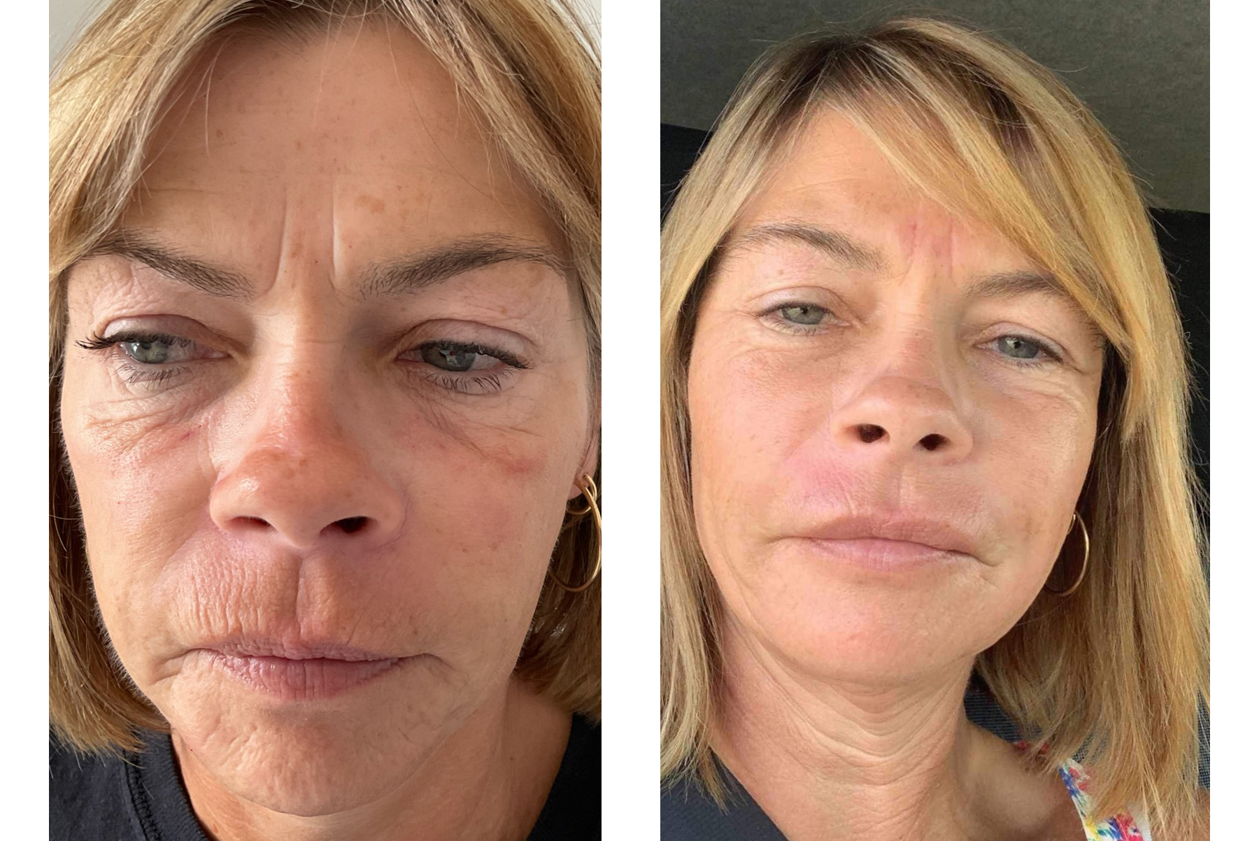 Derma Firming - This lovely lady had a bespoke package using skin boosters and Derma Firming. She is beyond thrilled with her results. 