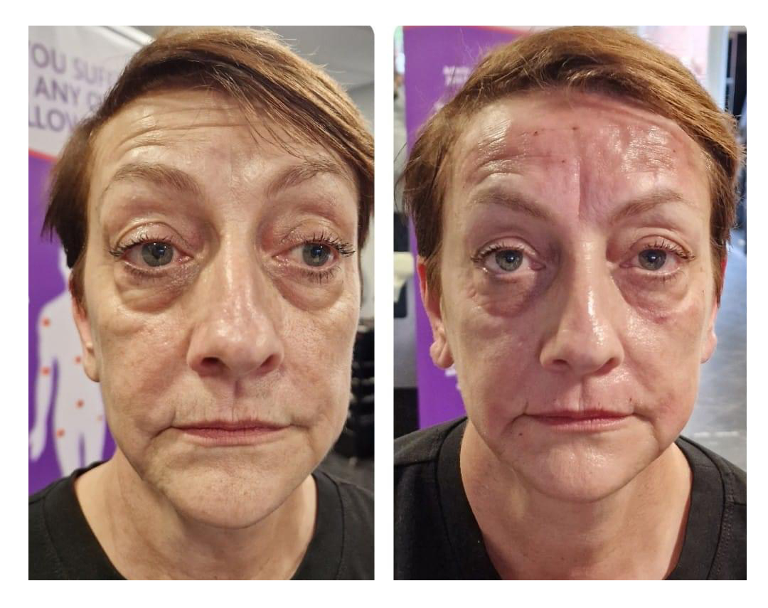 Derma Lifting / Derma Eye - This lovely lady had a Derma Lifting and a Derma Eye treatment, these are the results after one hour.