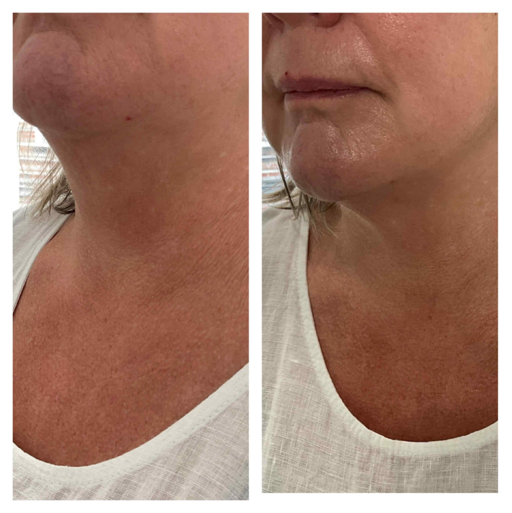 Dual Injector Pro after one treatment 