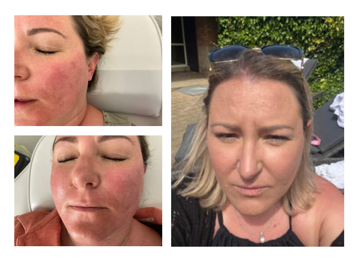 Hyaluronic Skin Booster - Our gorgeous client Leanne had a hyaloronic Skin Booster treatment, look at the glow on her skin after day 4!