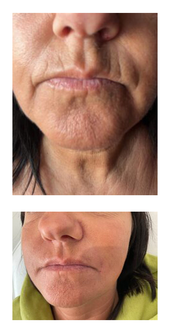 Mesotherapy - Our gorgeous client had Mesotherapy on her top lip. She is thrilled with the results!