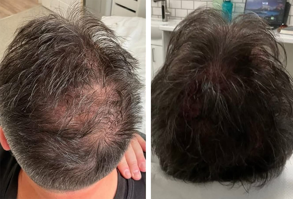 prp-hair-2